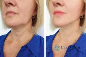 Double chin before and after Hi-Fu treatment 4 Book your double chin treatment Ashby Parva today! We are here to help!
