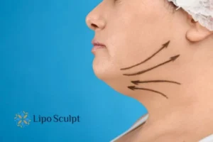 Double chin before and after Hi-Fu treatment 3 Boost your confidence with a Double chin treatment Ashby Parva
