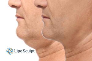Double chin before and after Hi-Fu treatment 2 Double chin treatment Ashby Parva from Lipo Sculpt - feel more confident today!