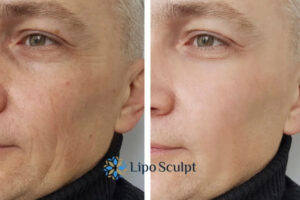 How to Fight Aging Symptoms 3 Fight Aging Symptoms Ashby Parva With HIFU and Morpheus8 Today!