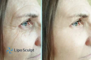 How to Fight Aging Symptoms 2 Do you want to Fight Aging Symptoms Ashby Parva? Contact Lipo Sculpt today!