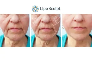 Explaining Morpheus8 And What It Can Do For You 3 Boost your confidence with Morpheus8 Ashby Parva call our team today!
