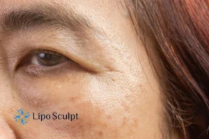 Cryopen: The Revolutionary Treatment for Age Spots Unveiled 2 Are age spots Ashby Parva giving you low self esteem? Contact us today!