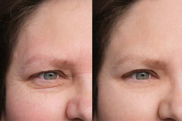 HIFU vs Botulinum Toxin: Understanding the Differences 4 How long do HIFU results last Ashby Parva?