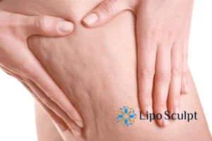 CoolSculpting for Legs: The Innovative Approach to Redefining Your Legs 5 Start your journey today book your coolsculpting treatment Ashby Parva online today!
