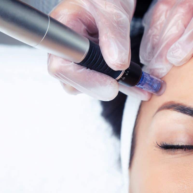 Morpheus8 treatment Ashby Parva from Lipo Sculpt - Book in today!