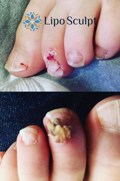 Wart removal customer results from Lipo Sculpt Ashby Parva