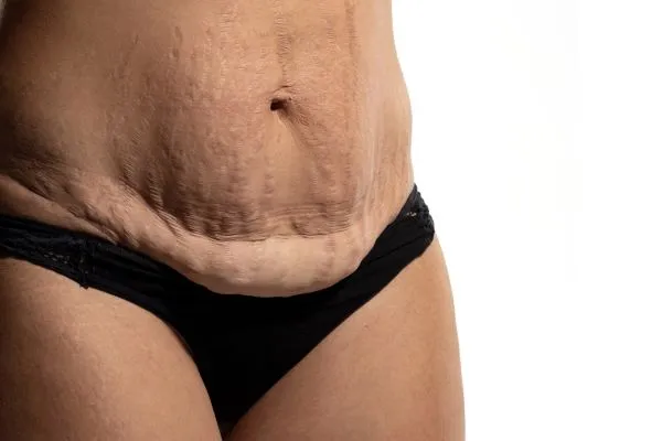 Lost the Weight but Not the Loose Skin? 1 image of womans stomach after weight loss showing loose skin Ashby Parva